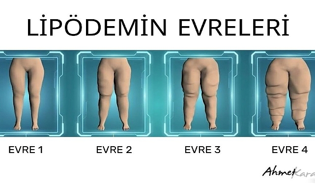 PROF. DR. AHMET KARACALAR UYARDI: BU BİR OBEZİTE DEĞİL, İLKEL ÇAĞLARDAN KALAN 'EVRİMSEL' BİR MİRAS